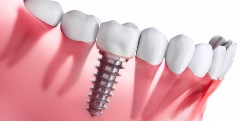 How much are dental implants?