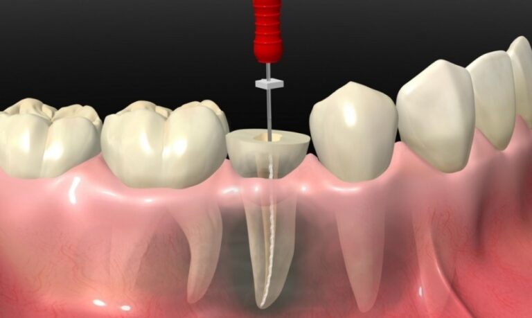 Root Canal Treatment Guide