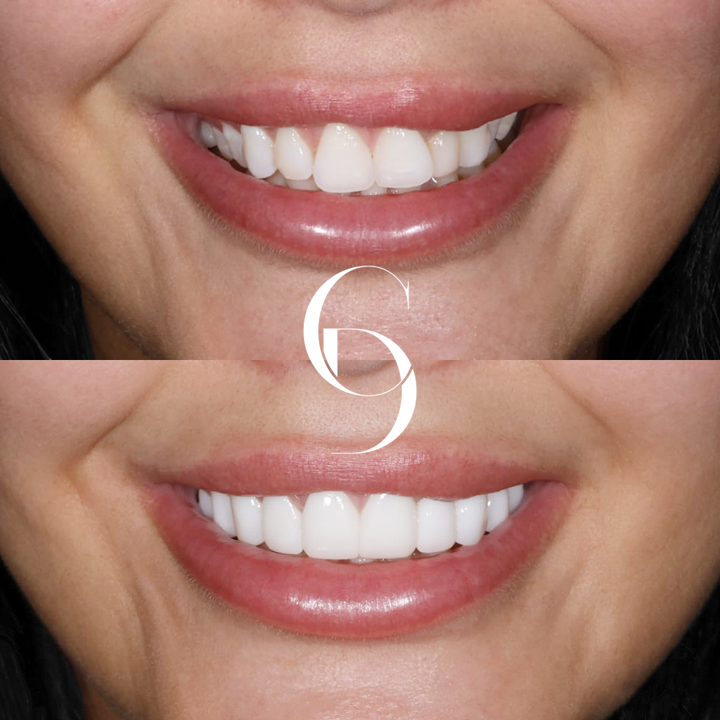 Frontal Before and After with Porcelain Veneers