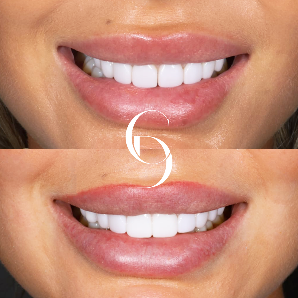 Can Porcelain Veneers Correct Lower Front Teeth Crowding in Bondi Junction?