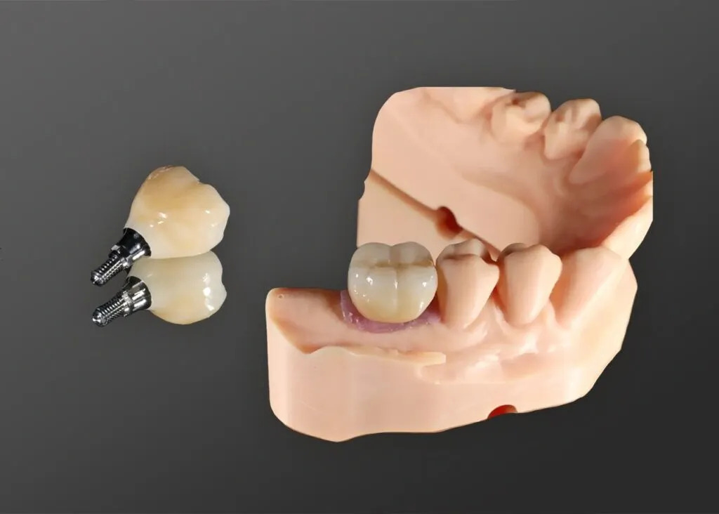 Dental Implant