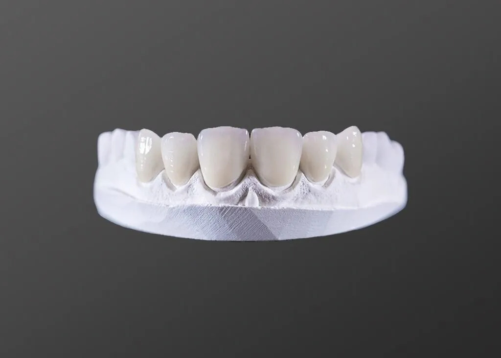 Dental Veneers